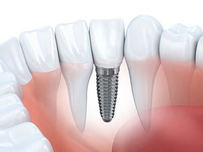 Dental Implants La Jolla